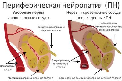 переферическая нейропатия
