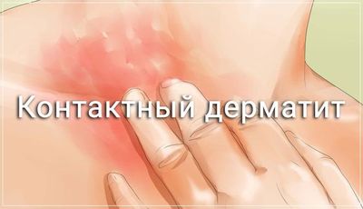 Контактный дерматит - одно из проявлений аллергии апизартрона