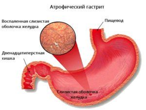Атрофический гастрит