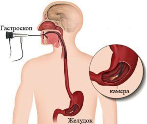 гастроскопия