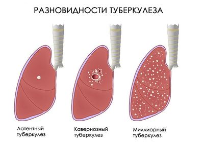 туберкулез виды