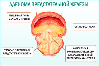 Отличительные особенности простатита бактериальной этиологии