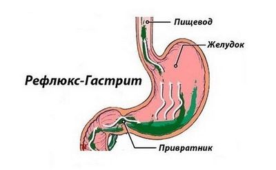 Билиарный рефлюкс-гастрит: причины, лечение и питание