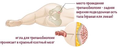 трепанобиопсия