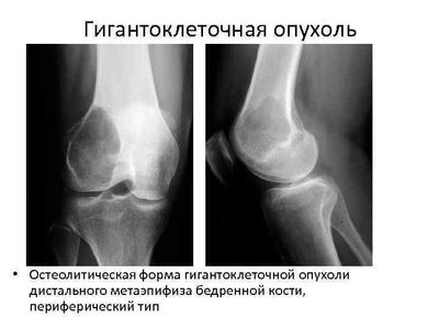 обследование кости