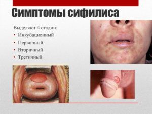 бытовой сифилис