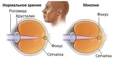 Близорукость (миопия) причины