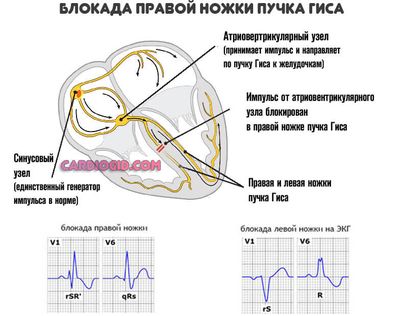 блокада-правой-ножки-гиса