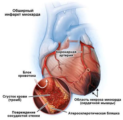 инфаркт миокарда
