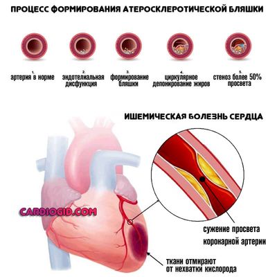 ишемическая болезнь сердца