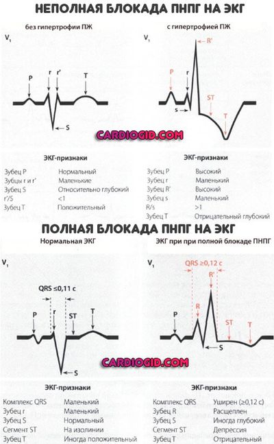 блокада-правой-ножки-пучка-Гиса-на-ЭКГ