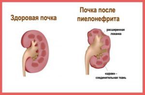 почки