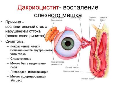 Дакриоцистит
