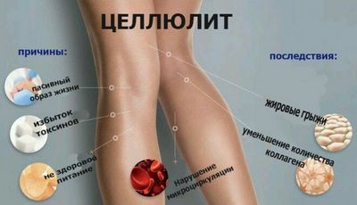 Целлюлит на попе и ногах, причины, как избавиться в домашних условиях