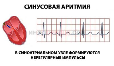 Что делать при синусовой аритмии у ребенка или подростка?