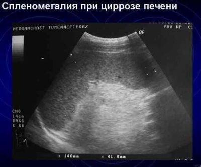 Спленомегалия при циррозе на УЗИ