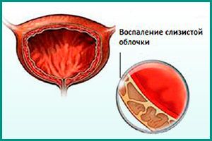 Цистит в начале беременности: чем опасен, как лечить
