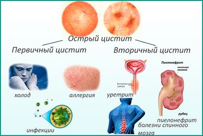 Острый цистит