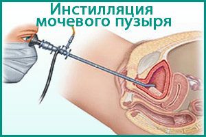 Инстилляция мочевого пузыря