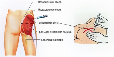 дексаметазон уколы