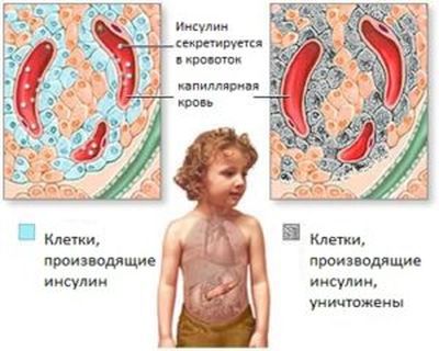 сахарный диабет 1 типа у детей