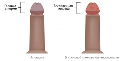 баланопостит-1