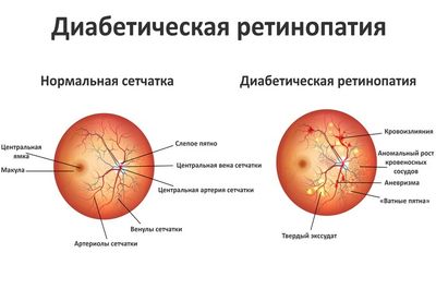 диабетическая ретинопатия