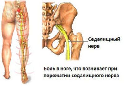 Ишиас