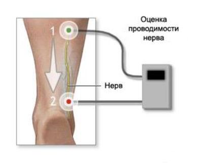 Проведение процедуры ЭНМГ