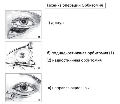 орбитомия