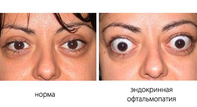 норма и патология эндокринной офтальмопатии
