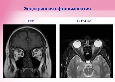 кт эндокринной офтальмопатии
