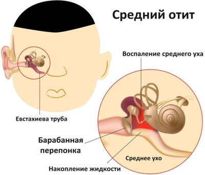 Фурацилин для ингаляций небулайзером