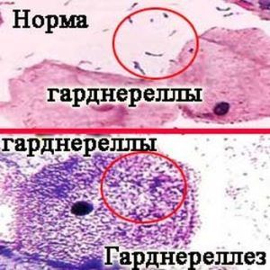 гарднерелла