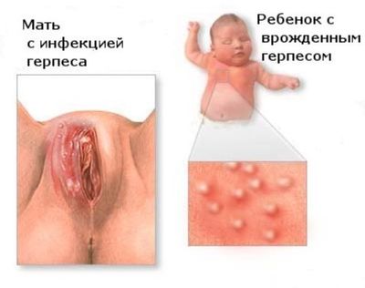 Герпес при беременности 2 триместр ребенок