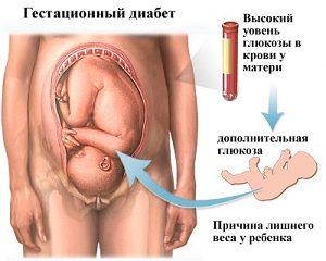 Последствия гестационного диабета