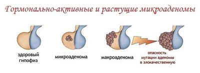 Гормонально-активные микроаденомы гипофиза