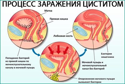 Процесс заражения циститом