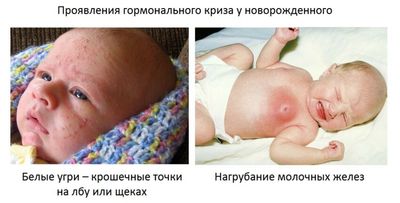 гормональный криз у новорожденных