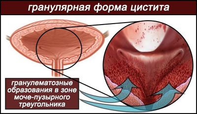 гранулематозные