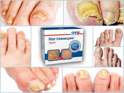 Средства для снятия ногтевой пластины с большого пальца ноги