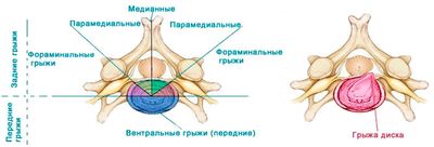 Виды грыж