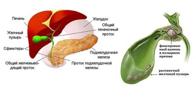 Проявления, симптомы и лечение холецистита у женщин