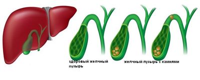 Холецистит Холецистит