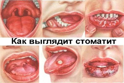 Холиса эффективно применяют в лечении стоматита