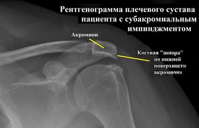 Рентген плечевого сустава