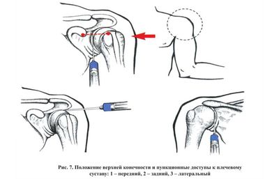 Инъекции в плечевой сустав