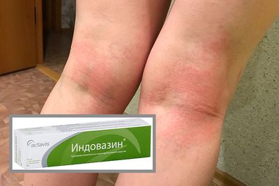 Мазь Индовазин: инструкция по применению и отзывы