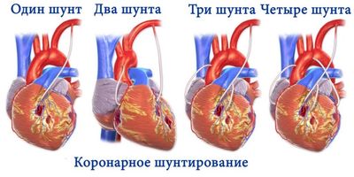 аортокоронарное шунтирование