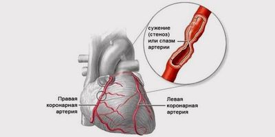 спазм сосуда сердца